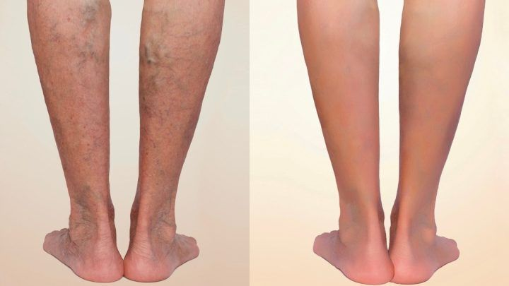Antes e depois do tratamento de varizes - Comparação de resultados